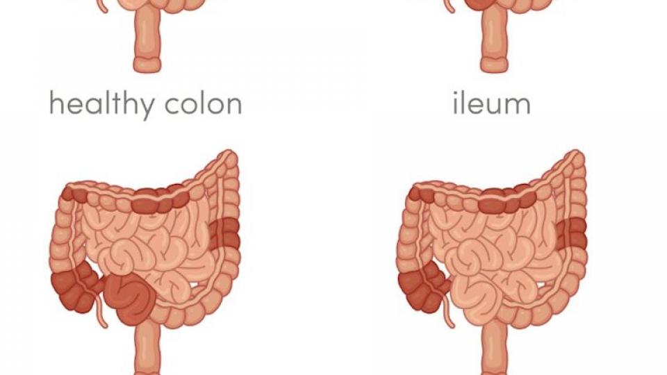 Νόσος Crohn : Τι είναι και πως προκαλείται 