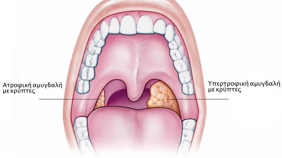 Αμυγδαλίτιδα : Ενημερωθείτε έγκαιρα 