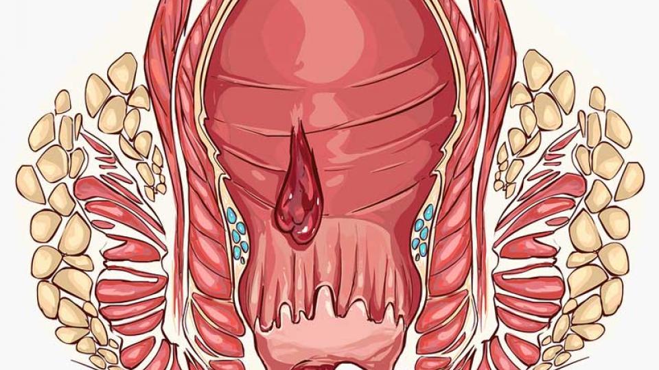 Αιμοροίδες : δείτε πως θα τις αντιμετωπίσετε 
