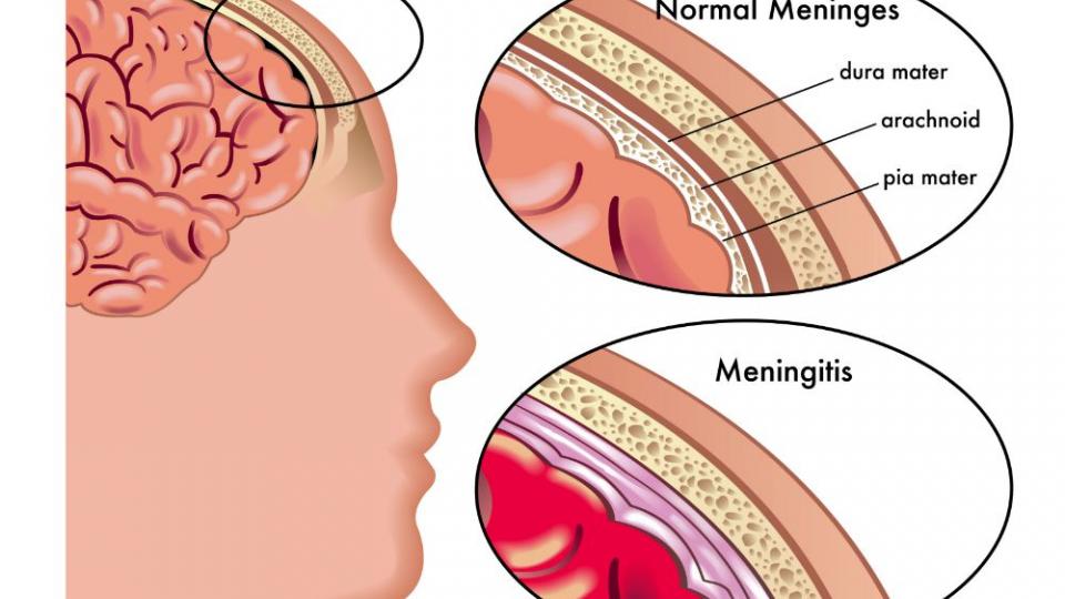 Μηνιγγίτιδα : Ποια είναι τα συμπτώματα στους ενήλικες και ποια στα βρέφη