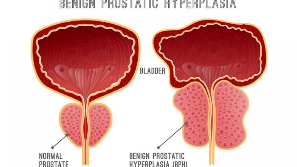 Φυσικές μέθοδοι αντιμετώπισης της καλοήθους υπερπλασίας του προστάτη, του Μάριου Δημόπουλου