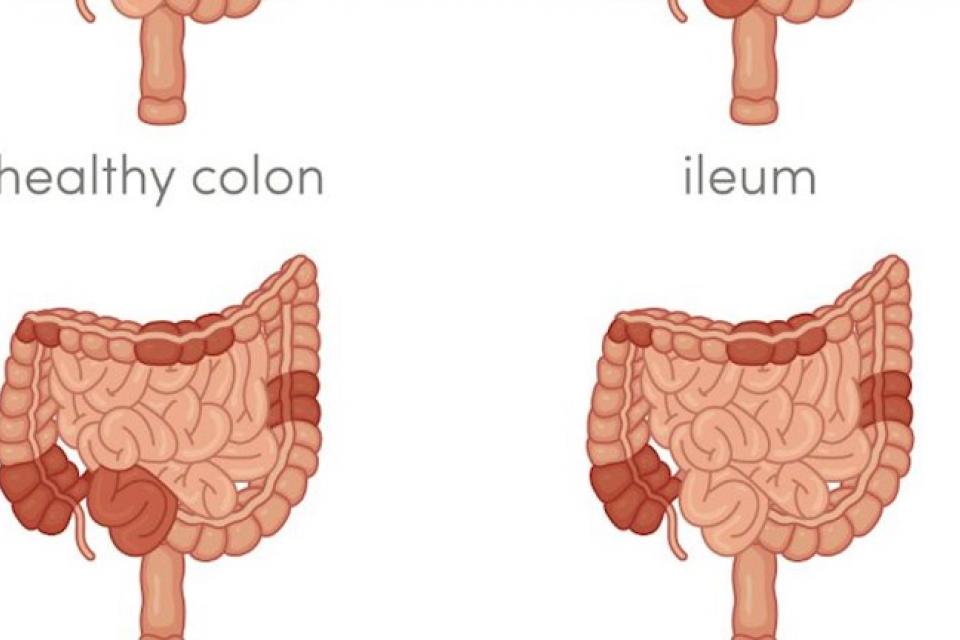 Νόσος Crohn : Τι είναι και πως προκαλείται 