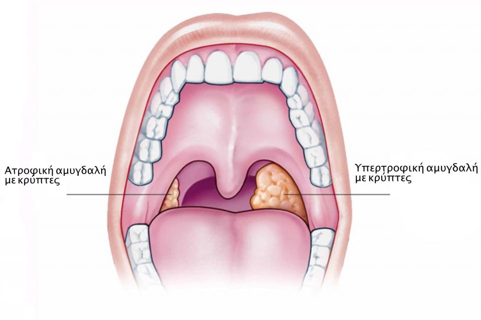 Αμυγδαλίτιδα : Ενημερωθείτε έγκαιρα 