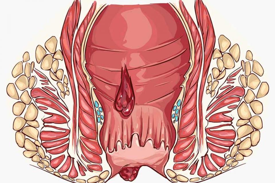 Αιμοροίδες : δείτε πως θα τις αντιμετωπίσετε 