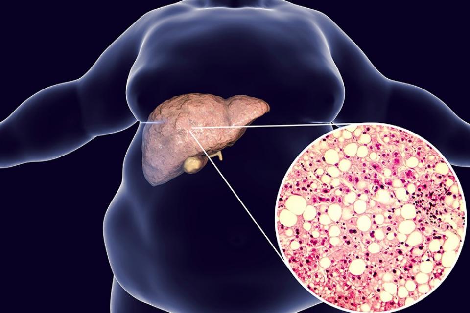 Μη αλκοολική λιπώδης ηπατική νόσος (NAFLD) - ΤΙ ΕΙΝΑΙ; ΚΙΝΔΥΝΟΙ